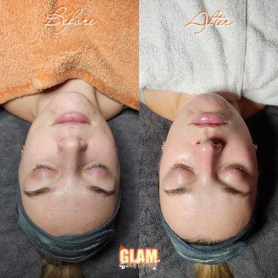 Deluxe facial before and after