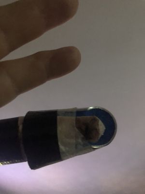 Splint unattended by a doctor I went to see