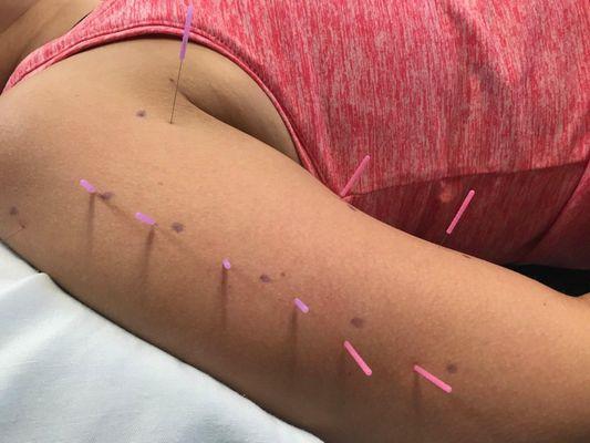 Dry needling treatment.