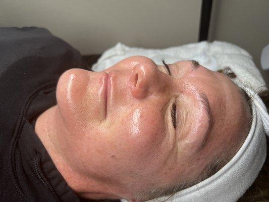 Dermaplane facial