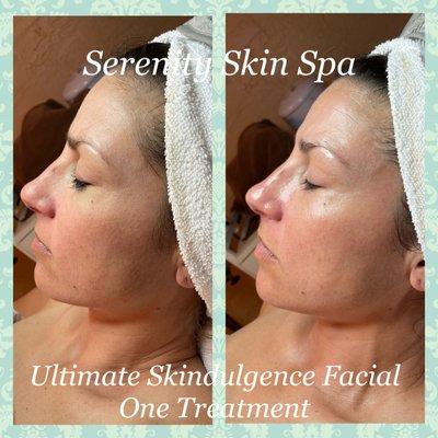 Look at this skin transformation!  The Ultimate Skindulgence Facial is an amazing combination of youthful results and pampering!