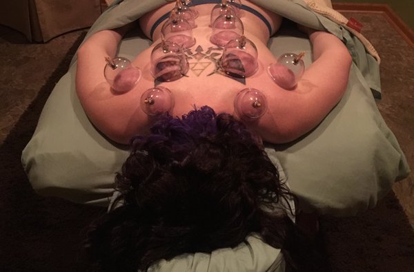 Cupping Therapy