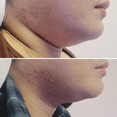 Double chin reduction with mesotherapy.