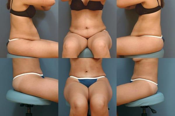 Learn more about tummy tuck surgery http://www.drruas.com/proc_tummy.html