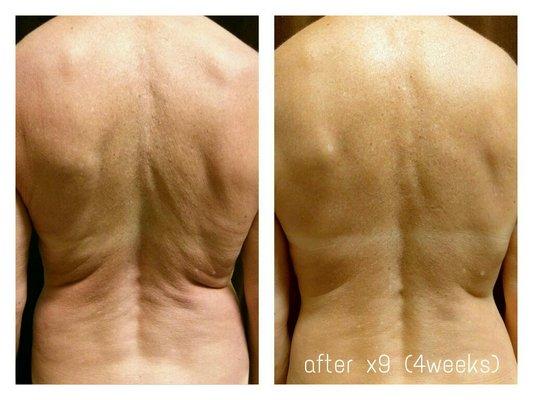 Effects of Firming Cupping Massage / Vacuum Therapy. Actual client before and after 9 sessions every 2-4 days.