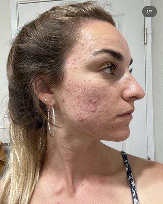 acne before I started working with Holly!