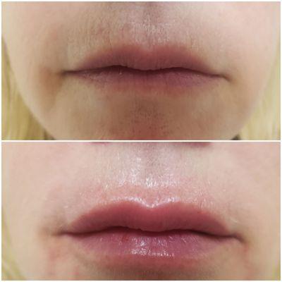 1 syringe of lip filler