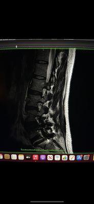 Degenerative disc disease, osteoarthritis and rotoscoliosis was "normal". also see multilevel nerve inpingement