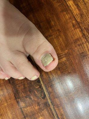 Damaged toe