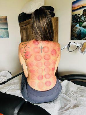 Cupping therapy