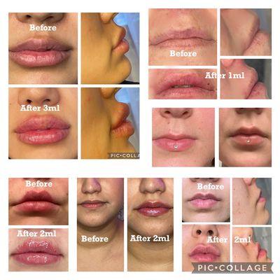 Needle free lip filler