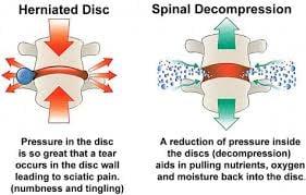 How decompression helps heal discs