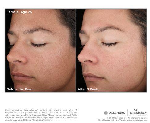 SkinMedica Resurfacing Peels