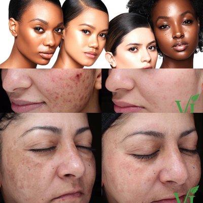 Vi Chemical Peel for all skin tones! Excellent treatment for anti-aging, acne scars, Melasma Mask and sun damage.