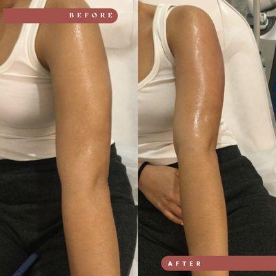 arm sliming treatment, arm sculpting