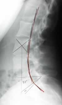 Case NS after five months of care. Now the alignment is correct and years of chronic low back pain are over.