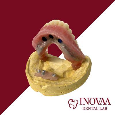 Mandibular Complete Denture with Implants 
(Implants not included)