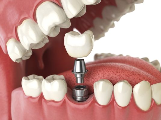 Dental implants are the permanent option to replace missing teeth. Many people suffer from tooth decay, periodontal disease, ...