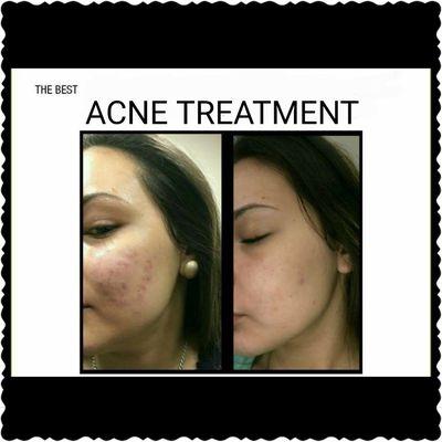 Acne treatments for all ages.