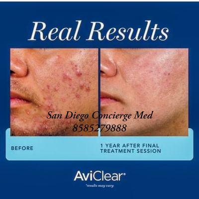 AviClear is the first and original FDA-cleared energy device for the treatment of mild, moderate and severe acne.