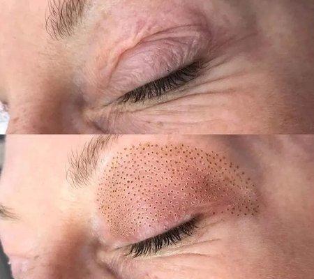 Plasma lift upper eye lifting treatment