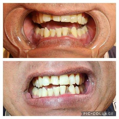 Night and day difference teeth Whitening