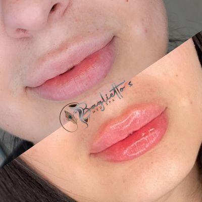 Lip hydration and enhancement