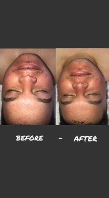 before & after of a MicroDermabrasion. (one session)