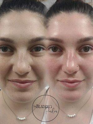 Collagen Induction Therapy (CIT) improves appearance of fine lines, wrinkles, acne, scarring and more!