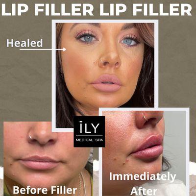 Lip Filler