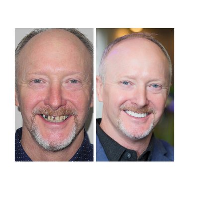 Before and after of Dr. Tieken's 2018 smile makeover winner! Nothing gets in the way of Dr. T creating a beautiful smile!