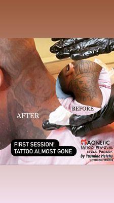 Before and after one session magnetic tattoo removal. 
Non-invasive 
100% no scars 
Works on all skin types
Works on all kinds of tattoos