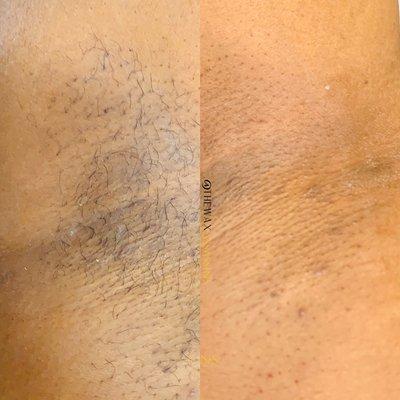 Before and After Underarm Wax