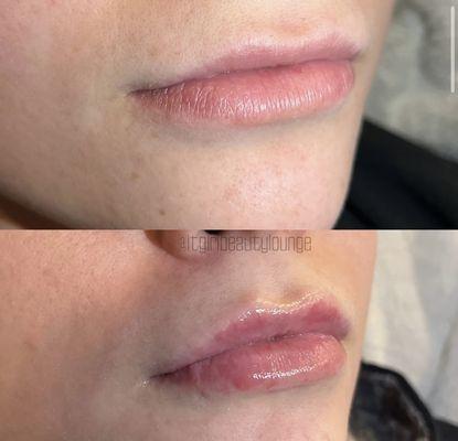 hyaluron lip filler