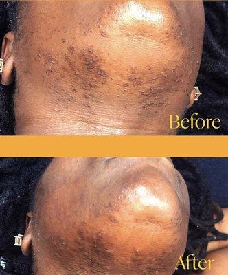 Chin wax before & after