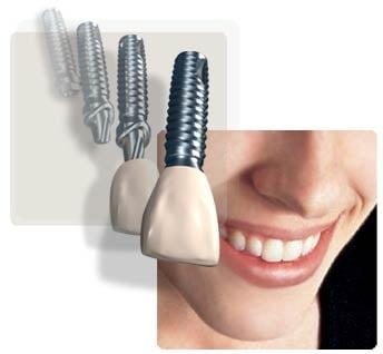 Dental Implant