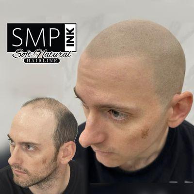 Soft, natural hairline, scalp micropigmentation