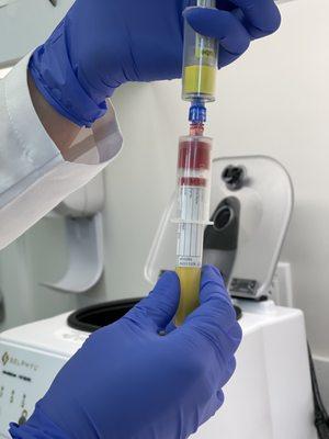 Platelet Rich Plasma (PRP) after centrifuge.