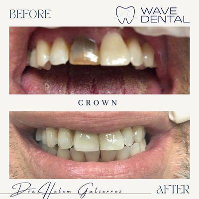 Root Canal & Crown