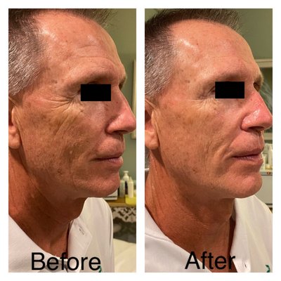 8 Point Face Lift Facial before and after photo