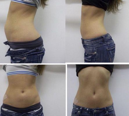 Laser Lipo