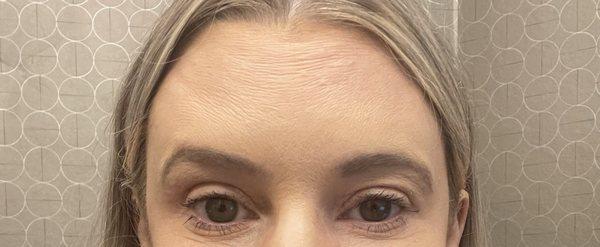 Final result after 90+ units of Botox to the forehead and $1500+