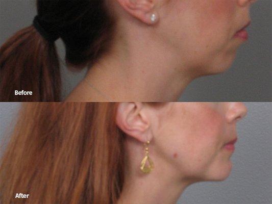 Genioplasty (Chin Implant)