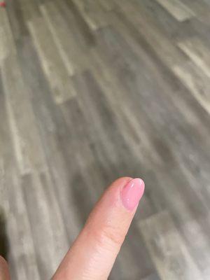 Exposed nail bed--very painful