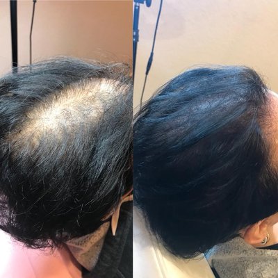 One of my clients before and after Scalp Micropigmentation treatment!