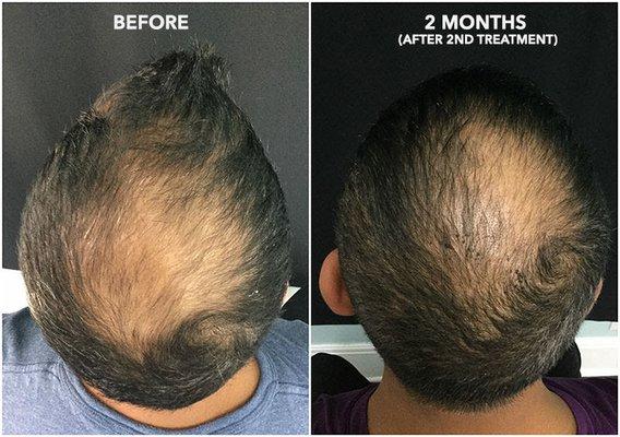 PRP (Platelets Rich Plasma) for hair growth