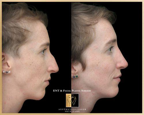 Rhinoplasty Hump Reduction