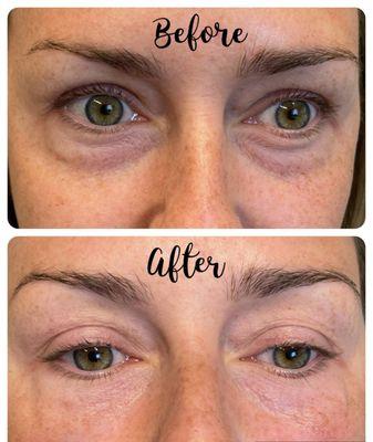 Undereye filler