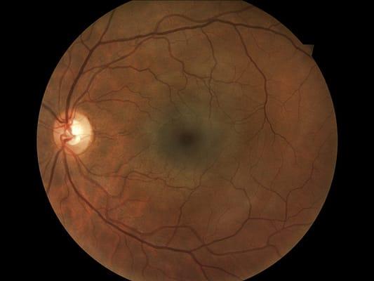 Retinal photos available!