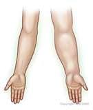 Lymphedema